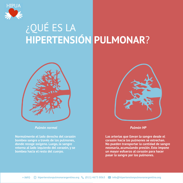 Hipertensión Pulmonar Una Condición Silenciosa Y Poco Frecuente ¿cómo